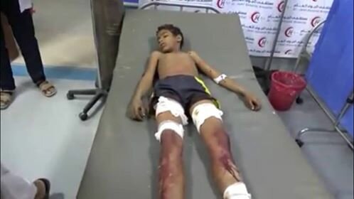 مقذوف لمليشيا الحوثي يتسبب بمقتل طفل و إصابة آخر