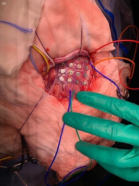 إيقاظ طفل خلال عملية جراحية في الدماغ بتخصصي الدمام